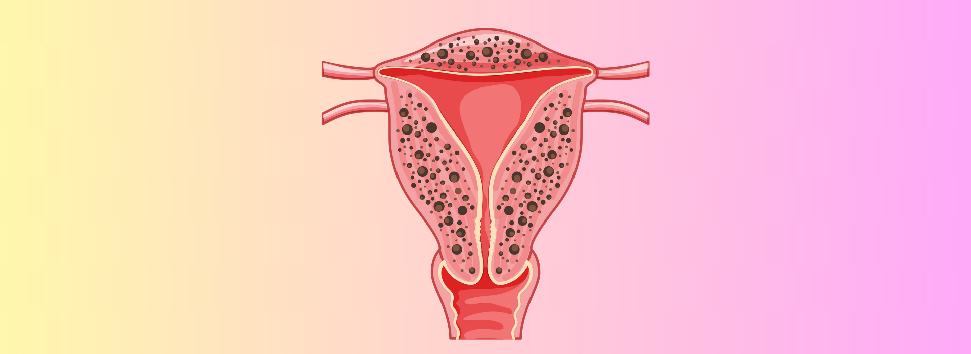 Adenomyozis Nedir? Belirtileri, Nedenleri ve Tedavisi