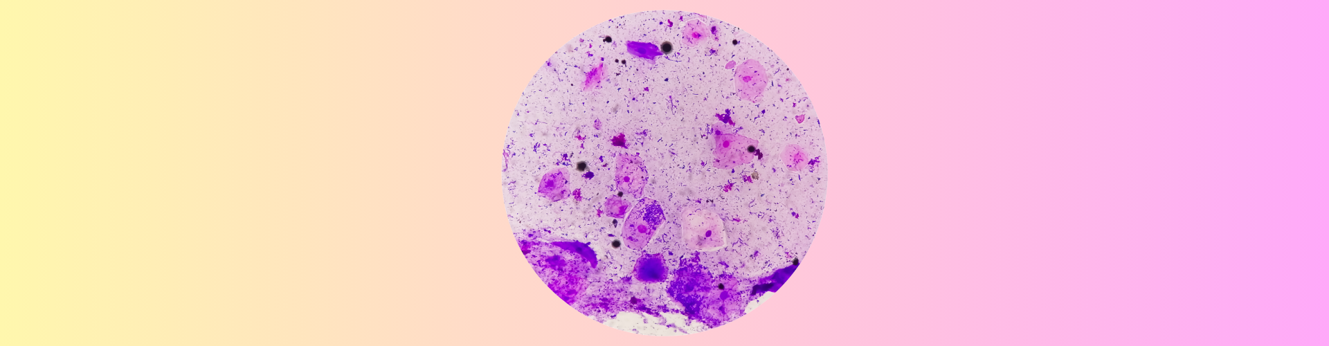 Vajinal Enfeksiyon Belirtileri Nelerdir?